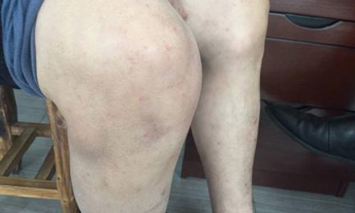 患者双膝有痛风石 药物治疗效果不佳 我院个性化治疗助其