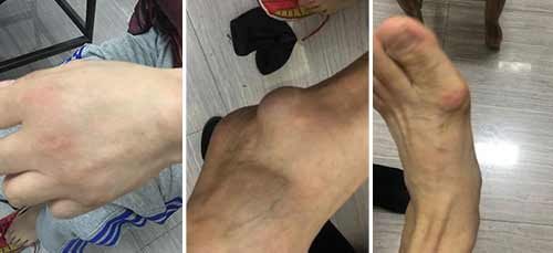来院看诊时,唐先生全身多处关节有大小不一痛风石 郑州痛风风湿病医院助患者告别十年痛风阴霾