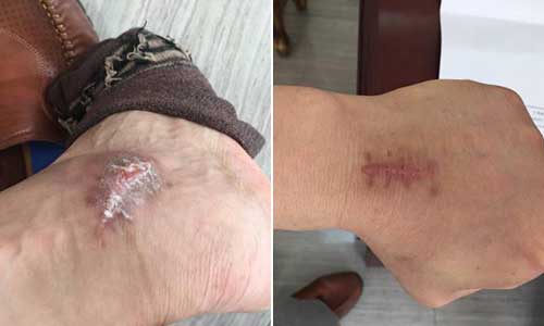 经过治疗,唐先生关节肿痛现象消失,痛风石 清除 郑州痛风风湿病医院助患者告别十年痛风阴霾