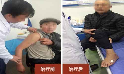 治疗前吴大爷右肩难以上举,治疗后吴大爷右肩可以正常活动 治疗父亲二十年痛风,病情已好转