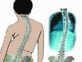 强直性脊柱炎患者怎么避免驼背、脊柱变形?