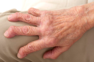 如何正确的来鉴别手指关节类风湿疾病呢?