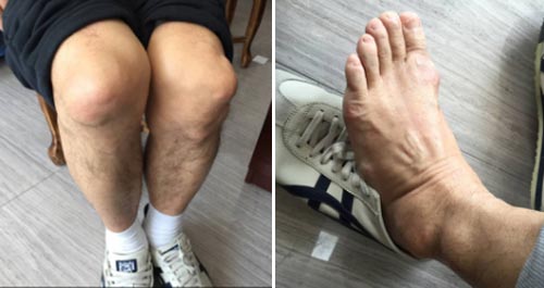 双膝、双足关节明显可见痛风石 经过郑州痛风风湿病医院专家三个多月的时间治疗,痛风现已恢复健康
