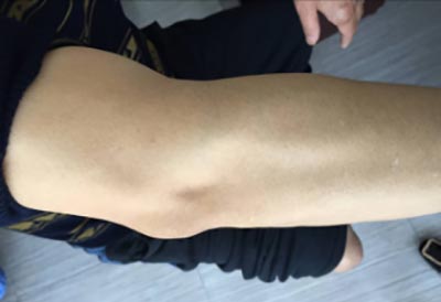 痛风多年治疗无效 郑州痛风风湿病医院医院科学治疗 经过郑州痛风风湿病医院专家三个多月的时间治疗,痛风现已恢复健康