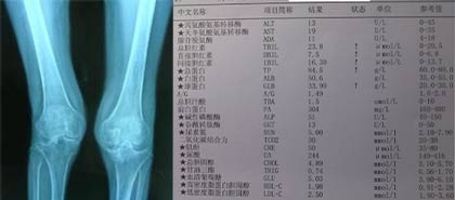 风湿性关节炎病史7年,郑州痛风风湿病医院治疗康复