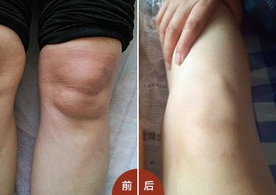 风湿性关节炎病史7年,郑州痛风风湿病医院治疗 