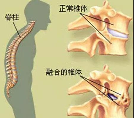 强直性脊柱炎早期患者应如何应对