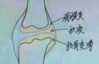 郑州治疗滑膜炎医院介绍不同程度的滑膜炎的临床表现差异较大