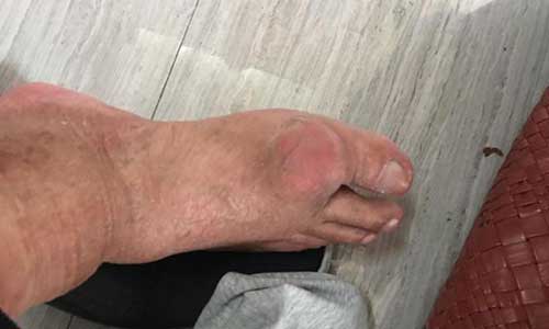 药物治痛风不彻底病情加重,来郑州痛风风湿病医院对症治疗 药物治痛风不彻底病情加重,来郑州痛风风湿病医院对症治疗