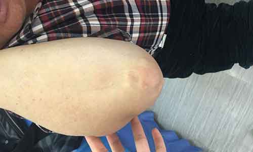 药物治痛风不彻底病情加重,来郑州痛风风湿病医院对症治疗 药物治痛风不彻底病情加重,来郑州痛风风湿病医院对症治疗