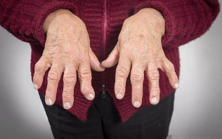 手指类风湿关节炎怎么治疗呢?