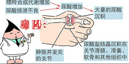 尿酸高就是痛风吗?人体尿酸主要来源于哪两个方面