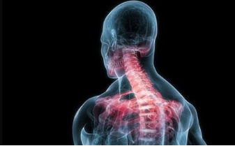 强直性脊柱炎患者有哪些典型的后果？