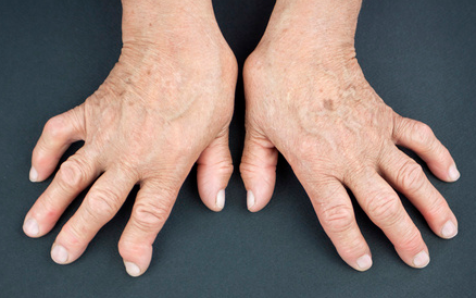 手指类风湿性关节炎的初期症状